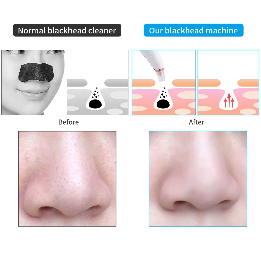 Blackhead Remover Tools Skin Care Cleaner USB Charging